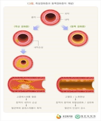 혈관 좁아진 죽상경화증 5년새 55% 늘어