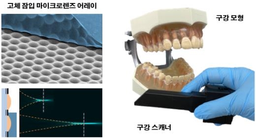 치아 본뜰 때 하는 3차원 구강 스캐닝을 휴대용 카메라로
