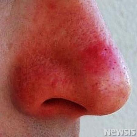겨울에 코 성형하면 딸기코 된다고?
