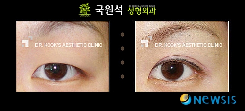 성형외과 전문의에게 듣는 쌍꺼풀 수술 잘하는 방법