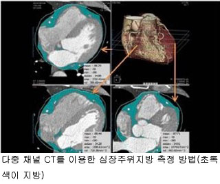 “심장 주위 지방 많으면 심혈관계 질환 위험 높아”