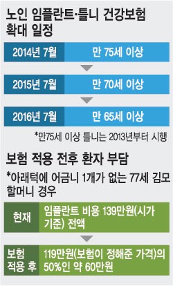 75세 이상 임플란트 비용 최대 3분의 1로 줄어든다