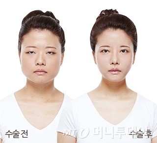퀵안면윤곽수술, 안전하고 완벽하게