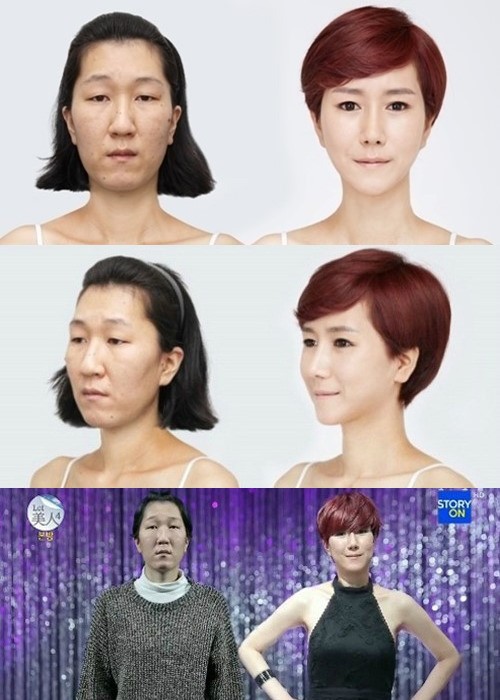 렛미인4 20대 할머니, 수술 비용이 무려…9477만원