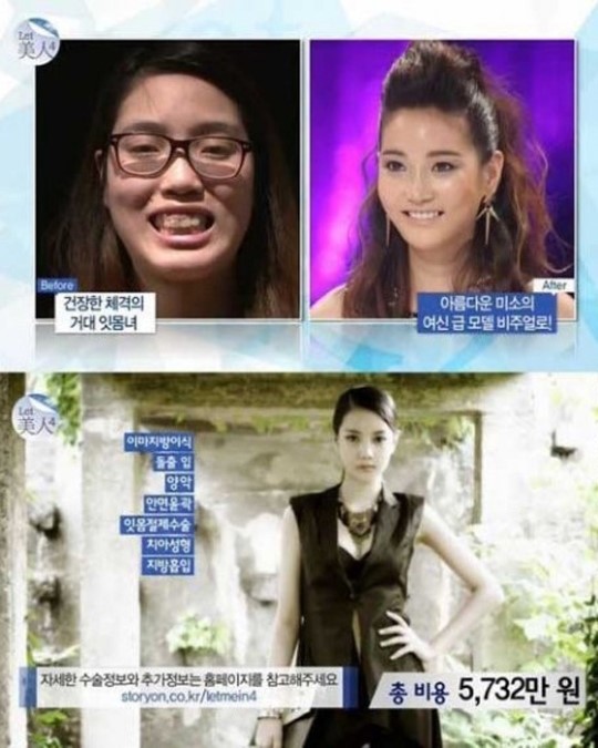 렛미인 박동희, 역대급 비포 에프터…수술 비용 얼마?