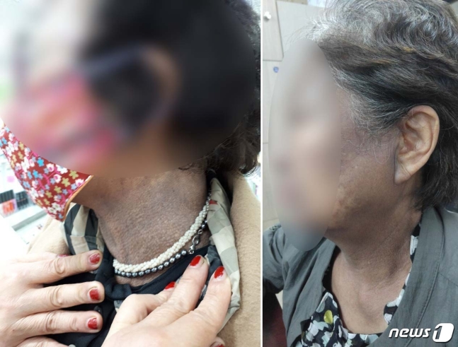 머리 염색하니 얼굴이 까맣게…헤나염색 부작용