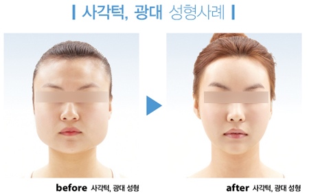 안면윤곽수술로 얼큰녀, 큰바위얼굴 졸업한다