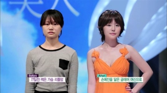`렛미인3` 가슴 괴사된 리틀맘, 수술 후‥