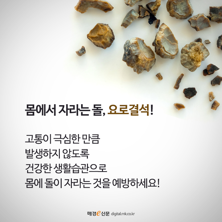 출산만큼 아프다는 요로결석, 방지하려면 이렇게