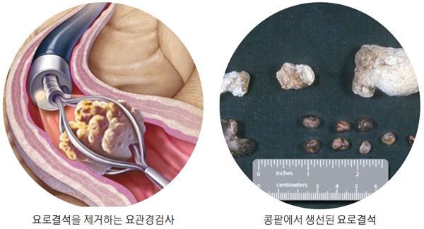 [Health] 땀 많은 여름철 옆구리 `쿡쿡`…요로결석 주의보