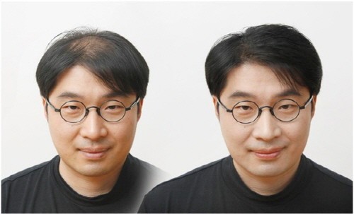 발머스한의원, 탈모치료 블랙서프라이즈 출시