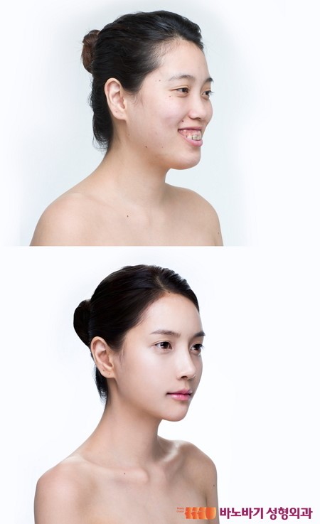 완벽 변신 렛미인 박동희, 자연스러운 이마와 코의 비결은?
