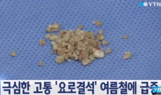 요로결석 증상, 갑작스런 복부 통증 심할 경우 구토, 혈뇨까지