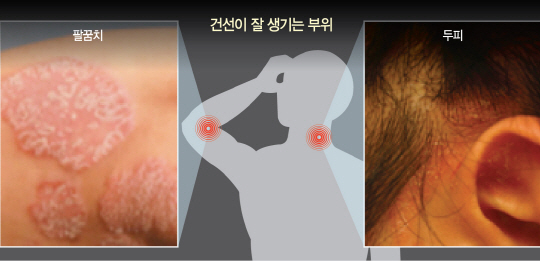 가을만 되면 온몸이 근질근질...습진 같은 너, 그이름은 건선