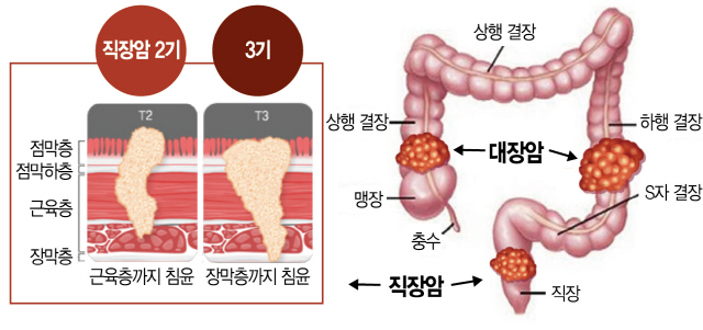 70대 3기 직장암 환자도 적극적 치료 받으세요