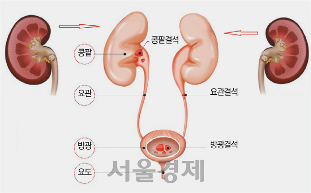 땀 흘린만큼 마셔라, 요로결석 생길라