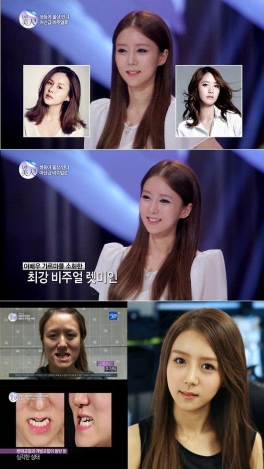 방미정, ‘렛미인’ 가장 예뻐진 순위 1위..소녀시대 윤아 닮은꼴