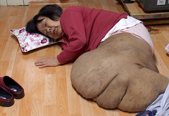 종양이 자라 코끼리 다리가 된 금순할머니의 안타까운 사연!