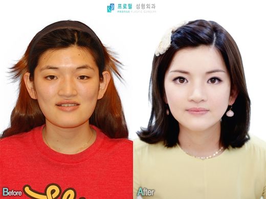 렛미인, 양악수술로 ‘괴물녀’ 완벽변신시키며 감동물결