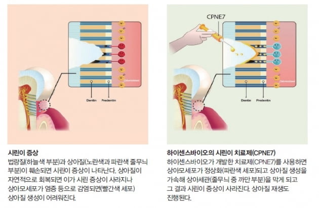 [넥스트 유니콘] 하이센스바이오, 잠든 상아모세포 깨워 충치와 시린이 해결한다
