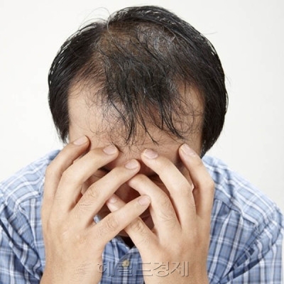 [제약톡톡] 탈모치료제 양대산맥 ‘프로페시아 vs 아보다트’…희비 갈렸다