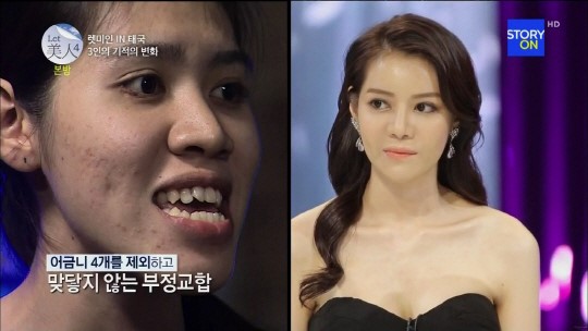 `렛미인4` 태국렛미인 차나펀, 심각부정교합 →연예인 외모 `특급 변신`