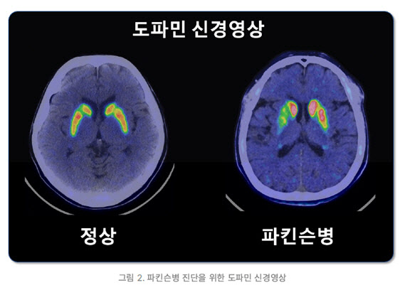 [굿닥터]신경세포 서서히 소실되는 파킨슨병, 도파민제 복용 통해 진행 늦춘다