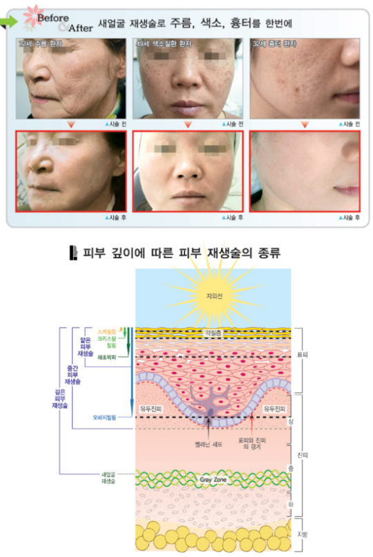 [건강]“낡고 헌 피부 줄게, 새 피부 다오”