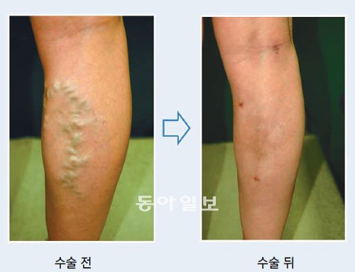 [헬스&뷰티]하지정맥류 허벅지·사타구니에도 생겨요