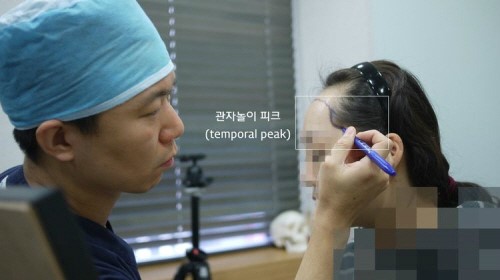 헤어라인 교정하면 어떤 모양이 될까?