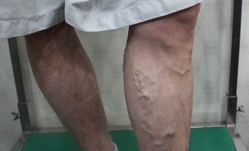하지정맥류는 여성병? 남성 환자 19% 증가