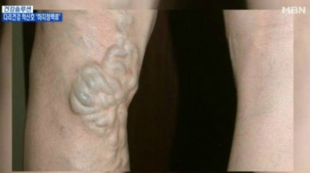 하지정맥류 예방법, 하이힐과 꽉 끼는 바지 치명적…‘다리 꼬지 말아야’