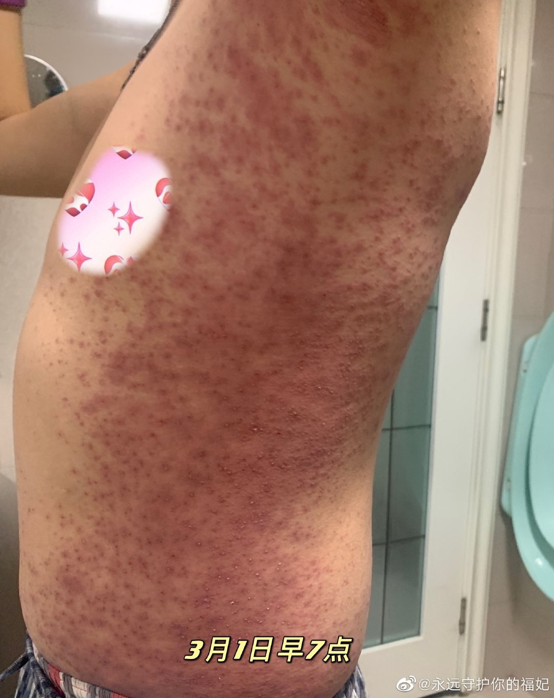 시노팜 백신 맞은뒤 온몸에 붉은 반점 中 뒤집은 사진 한장
