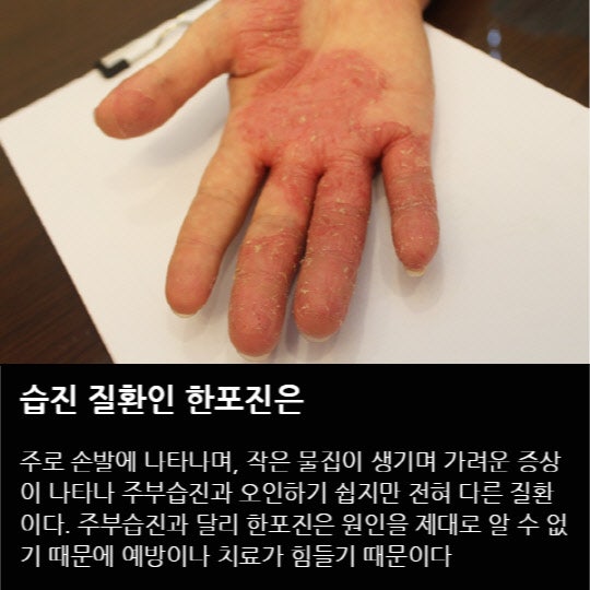 가려운 피부 물집