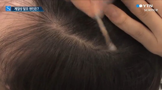 환절기 탈모 예방법, 봄철 머리 많이 빠져 특히 주의해야 ‘올바른 예방은?’