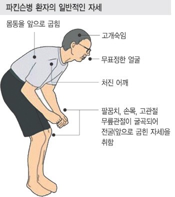 파킨슨병 환자, 약효 떨어지면 삶의 질 11% 저하