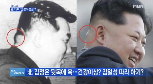 [뉴스빅5] 北 김정은, 건강이상설? 뒷목에 생긴 혹…과거 김일성도 있었다!