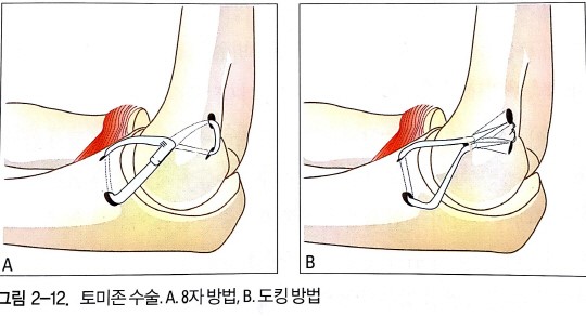 토미존수술 구속 증가 효과 없다-KBO부상관련 가이드북 펴내