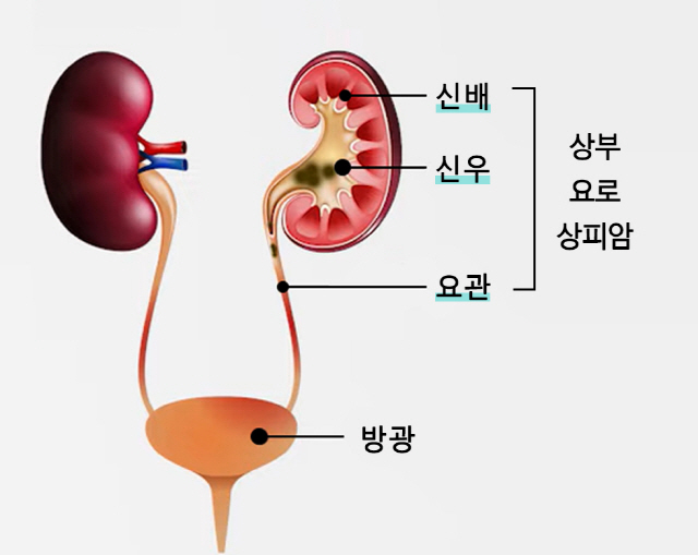 췌장암 진단 지표 CA19-9 높으면 상부요로상피암 재발·사망 위험 증가