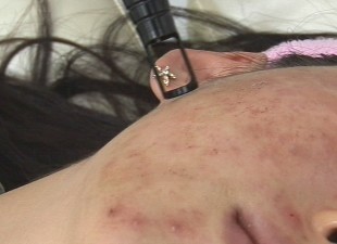 [건강] 여드름 완전정복, 양·한방 협진 효과 좋다