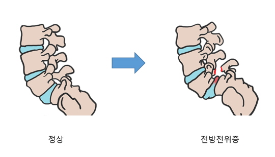 [김태겸, 척추이야기] 허리통증 지속? 척추전방전위증