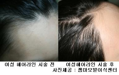 성형보다 중요한 ‘헤어라인’만들기