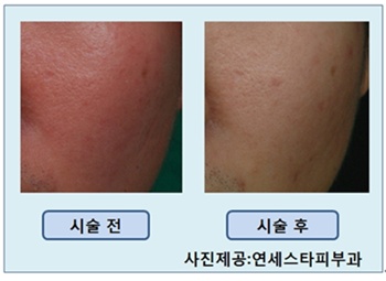 추운 겨울‘안면홍조’, 그냥 두지 마세요