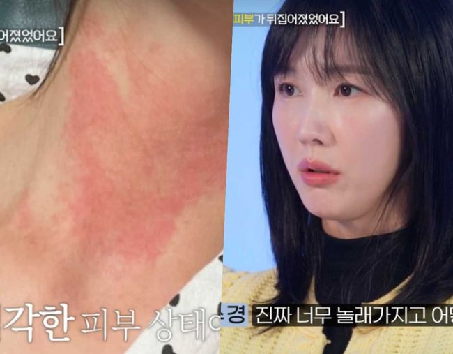 은퇴고민 이수경, 4년 공백기 이유 원인불명 피부병 걸렸다 (솔로라서) [핫피플]