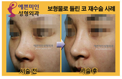 코 재수술, 들려 보이는 코 훤히 보이는 콧구멍 스트레스
