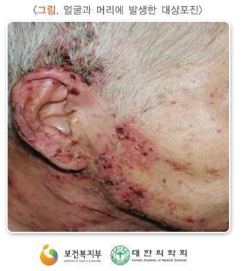 경북 경산시, 무더위 지치기 쉬운 중·고령층...‘대상포진’ 주의 당부