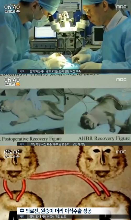 원숭이 머리 이식 성공 이탈리아 출신 의사...프랑켄슈타인 박사로 불려