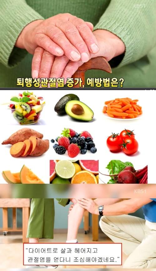 퇴행성관절염 예방법? 고구마-당근- 감 등 항산화제 포함된 음식 섭취하면 도움