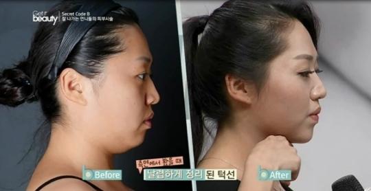 얼굴리프팅, 속 근육부터 단단하게 잡아라!