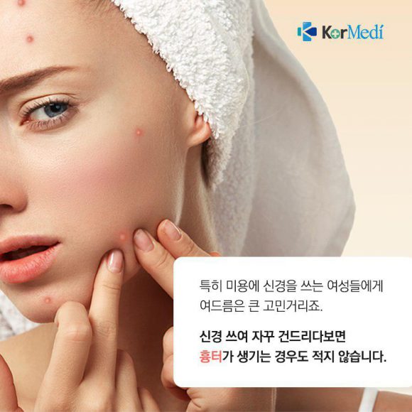 여드름 흉터, 평생 가지 않으려면?